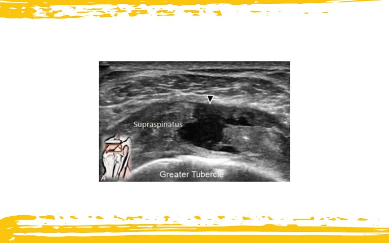 Manguito rotador tempo formacion 3.jpg